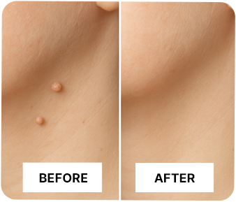 NutriDermaGuard Skin Tag Remover Benefits